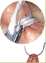 MiniMizer Adjustable Gastric Band - Bariatric Solutions: Bariatric Surgery